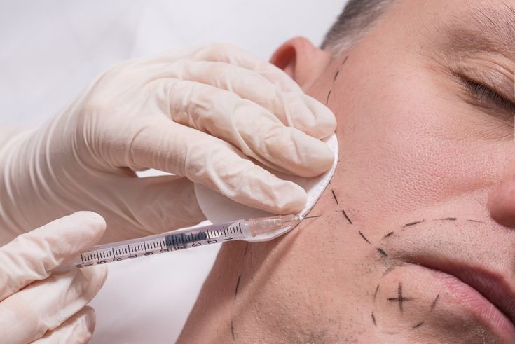 Beard Transplant Beard Transplant Image